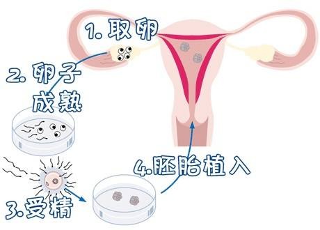 试管捐卵机构
